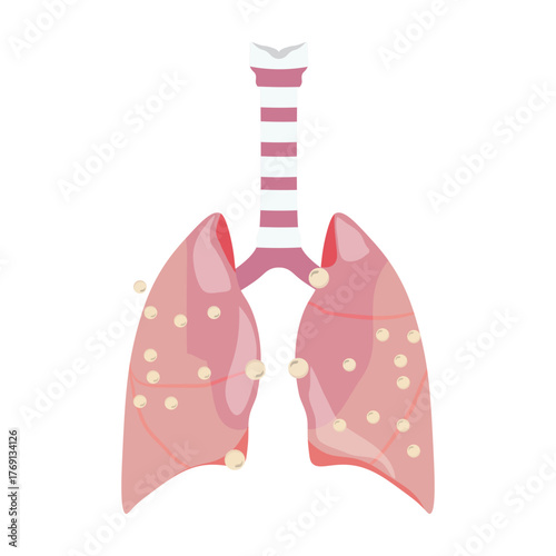 Pneumonia Illustration
