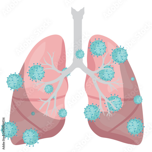 Pneumonia Illustration