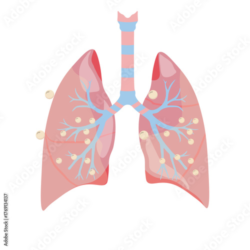 Pneumonia Illustration