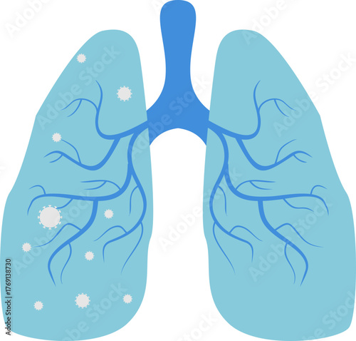 Pneumonia Illustration
