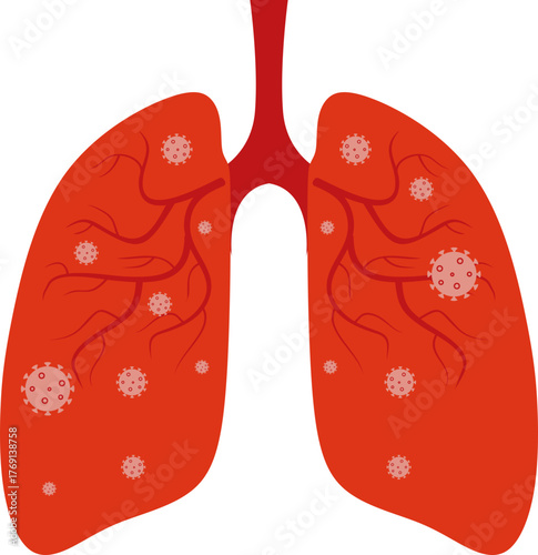 Pneumonia Illustration