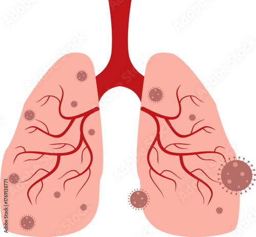 Pneumonia Illustration