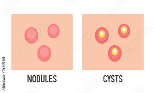 Nodules and Cysts. Acne type. Vector flat illustration