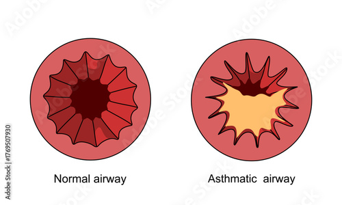 Asthmatic illustration. Normal airway and Asthmatic, shortness of breath. Inflammation of the bronchial tubes, thick mucus in the lungs. Vector illustration for medical, health, and clinics.