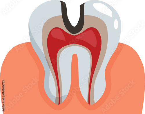Cross section of a decaying tooth with inflamed pulp and receding gums, illustrating pulpitis and periodontitis
