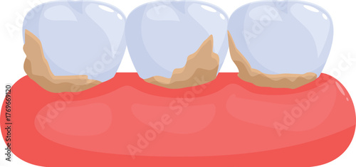 Cartoon teeth showing the accumulation of tartar and plaque, emphasizing the importance of dental hygiene