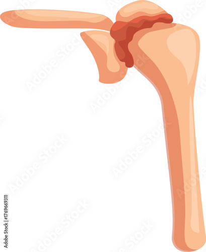 Medical illustration showing inflammation of the glenohumeral joint, causing pain and immobility