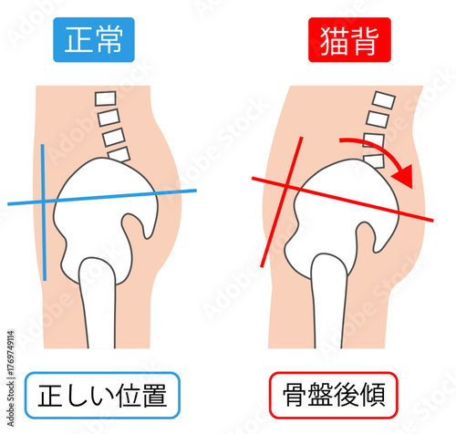 猫背の骨盤後傾と正常な骨盤の位置