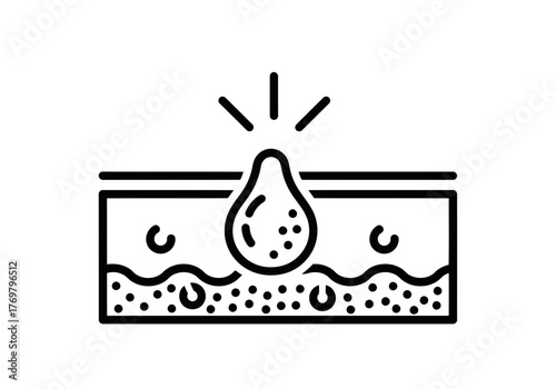 A illustration showing a skin layer with pore and a pimple above it with irritation icons