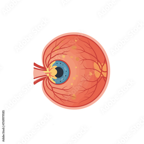Detailed anatomical cross-section of a human eye showing internal structures and potential retinal deposits.