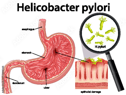 Helicobacter pylori Infection Causing Stomach Ulcer and Epithelial Damage