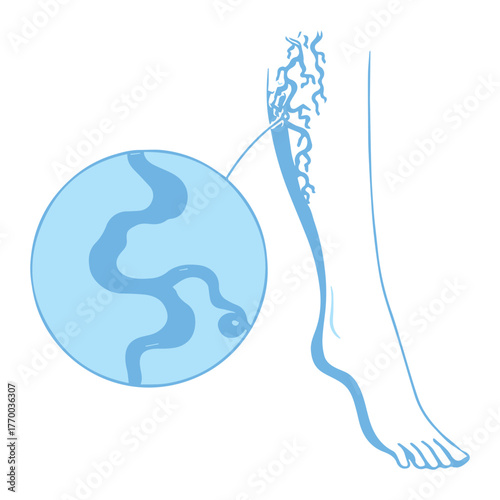 Varicose Veins Illustration