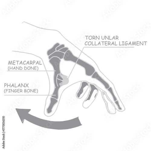 Hand Ligament Injury Diagram