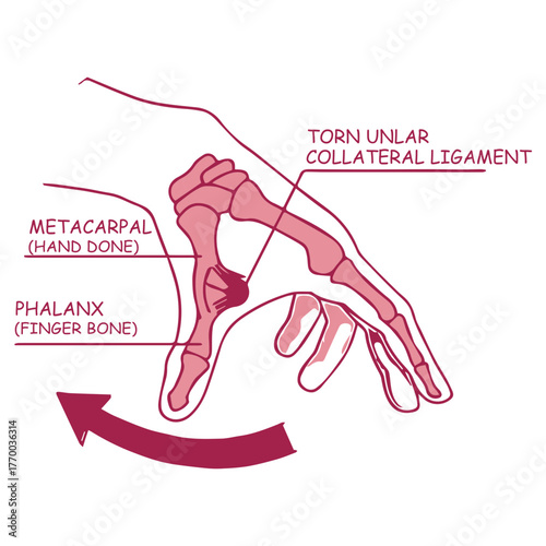 Thumb Ligament Injury Diagram