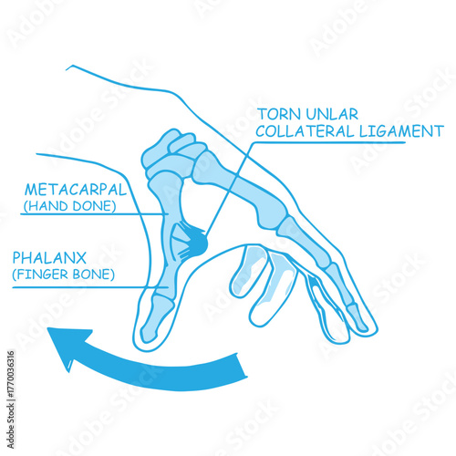 Thumb UCL Tear Diagram