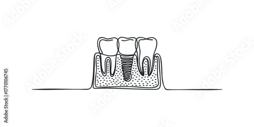 Dental implant and tooth anatomy diagram