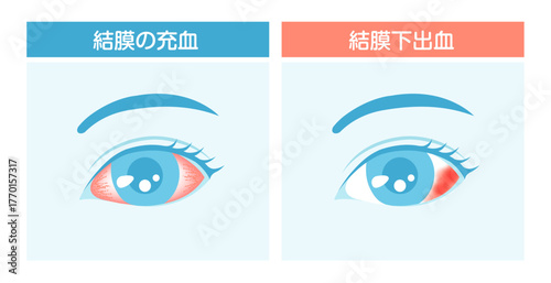結膜下出血と結膜の充血 比較ベクターイラスト