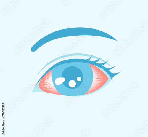  Conjunctivitis (pink eye) vector illustration