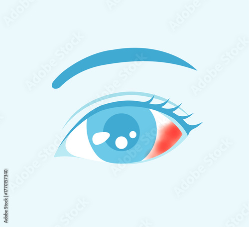 Vector illustration of subconjunctival hemorrhage