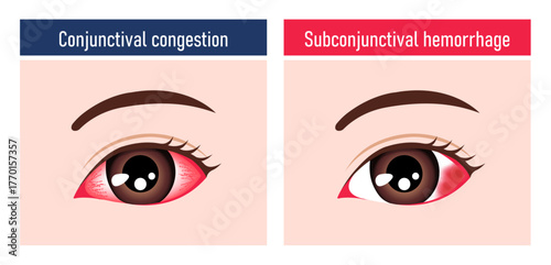 Illustration comparing subconjunctival hemorrhage and conjunctival congestion