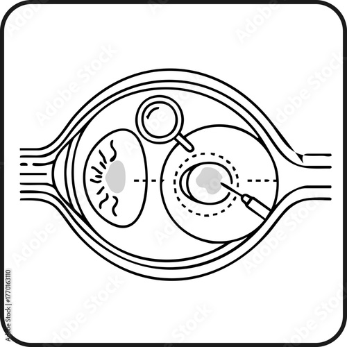 Eye Cataract Surgery