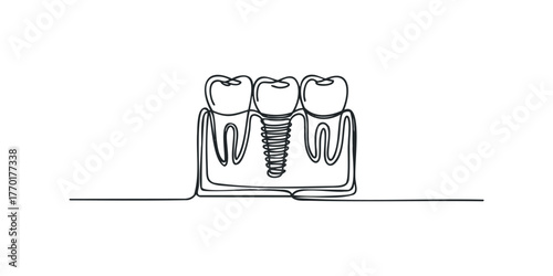 Dental implant supporting three teeth with roots visible