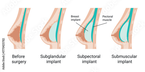 Breast anatomy before Surgery. Subglandular and submuscular placement types. Flat vector illustration