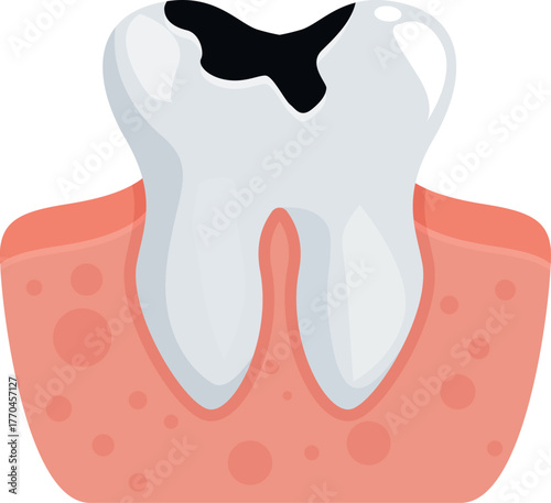 Damaged tooth with large black cavity showing in need of dental work