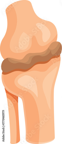 Medical illustration showing knee bones affected by osteoarthritis or arthritis with damaged cartilage