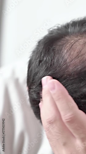 Androgenic alopecia, hair loss, male pattern baldness, man showing his visible bald area. High quality 4k footage