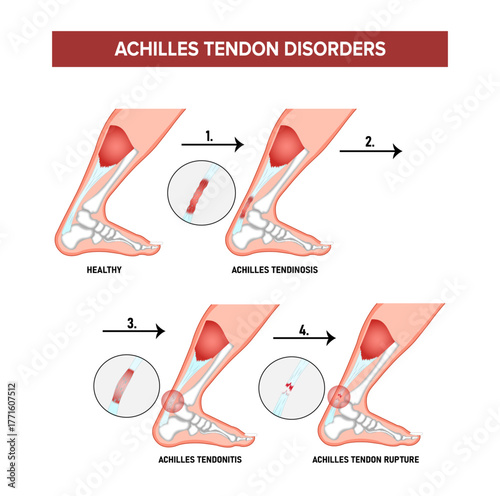 Achilles Tendon Rupture Injury Feet Calf Stock Vector Illustration 