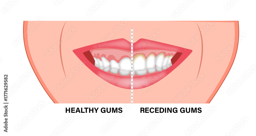 Obraz premium Gingivectomy Gum Graft Smile Small Teeth