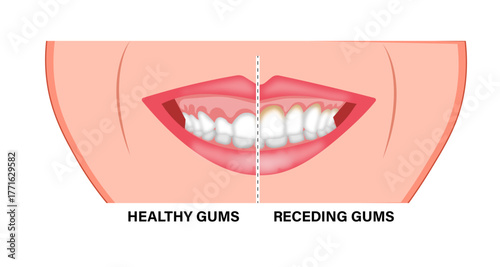Gingivectomy Gum Graft Smile Small Teeth 