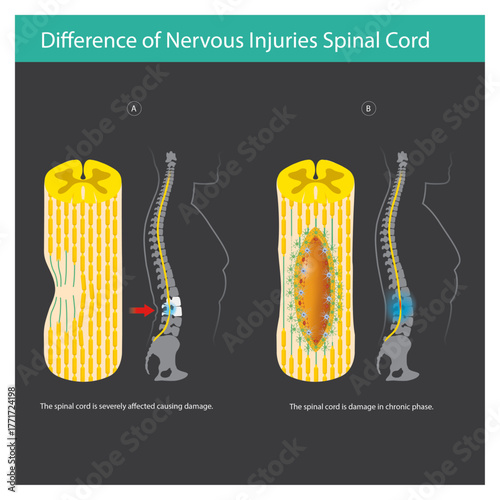 Acute and Chronic Spinal Cord Injury
This diagram illustrates the difference between an acute (A) and chronic (B) spinal cord injury. 