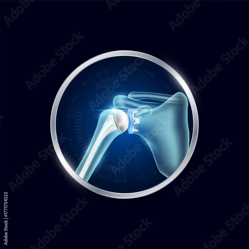 Artificial joints in circle frame label aluminum. Shoulder replacement or Prosthetic implant. Orthopedic technology surgery for treatment arthritis damaged cartilage. Medical product vector.