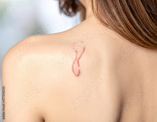 Wallpaper Mural Blizna bliznowiec na ciele Torontodigital.ca