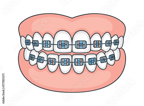 Human mouth with dental braces on teeth