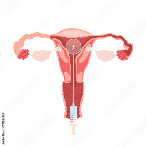 Female uterus. Female Reproductive System. In Vitro Fertilization (IVF) Medical Procedure. Medical education diagram for use in infographics on gynecology.