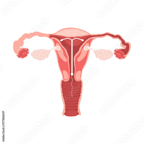 Female Reproductive System with IUD Contraception