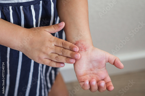 Close-up of child s hands with red irritated skin atopic dermatitis on the wrist, showing symptoms allergy, inflammation, sensitivity, highlighting dermatological problems and need for skin treatment