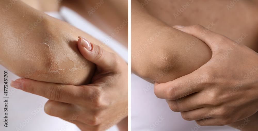 Ταπετσαρία Woman with dry skin on elbow before and after moisturizing treatment, closeup