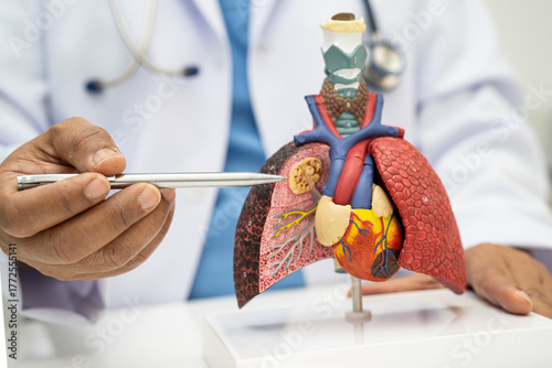 Pneumonia, lung cancer, Asian doctor holding human anatomy model for study diagnosis and treatment in hospital.