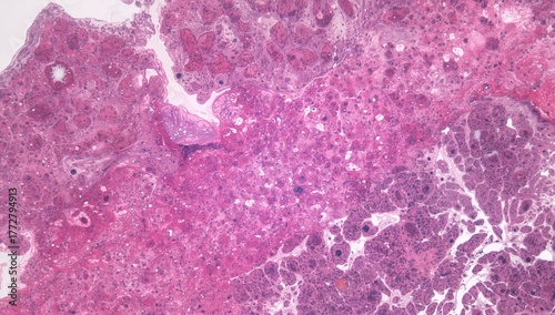 Benign Lipoma Growth in Arm...