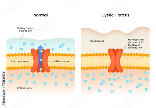 Cystic Fibrosis Normal vs Mutated CFTR Channel Function