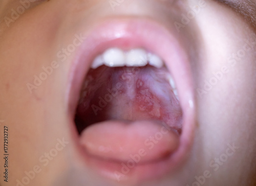 Oral lesions showing hand foot and mouth disease