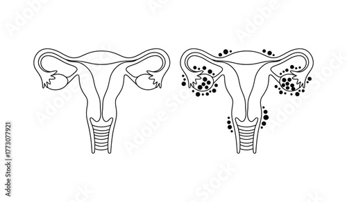 Illustration comparing a healthy uterus and fallopian tubes with one showing signs of disease or blockage.