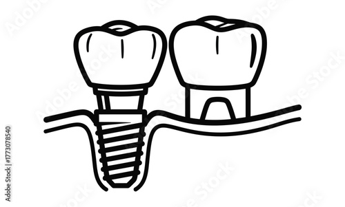 A dental implant screw is shown being placed into the jawbone next to a natural tooth.