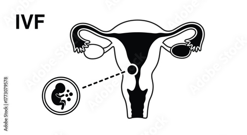 Diagram illustrates the process of In Vitro Fertilization (IVF) to achieve pregnancy, depicting a fetus and embryos.