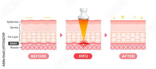 Vector illustration of HIFU mechanism and effect.