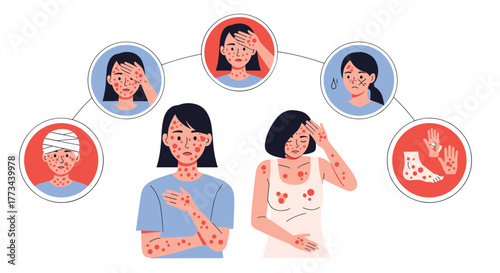 Illustration showing various symptoms of an infectious disease or viral illness, featuring individuals experiencing widespread skin rashes, fever, headache, and general discomfort.